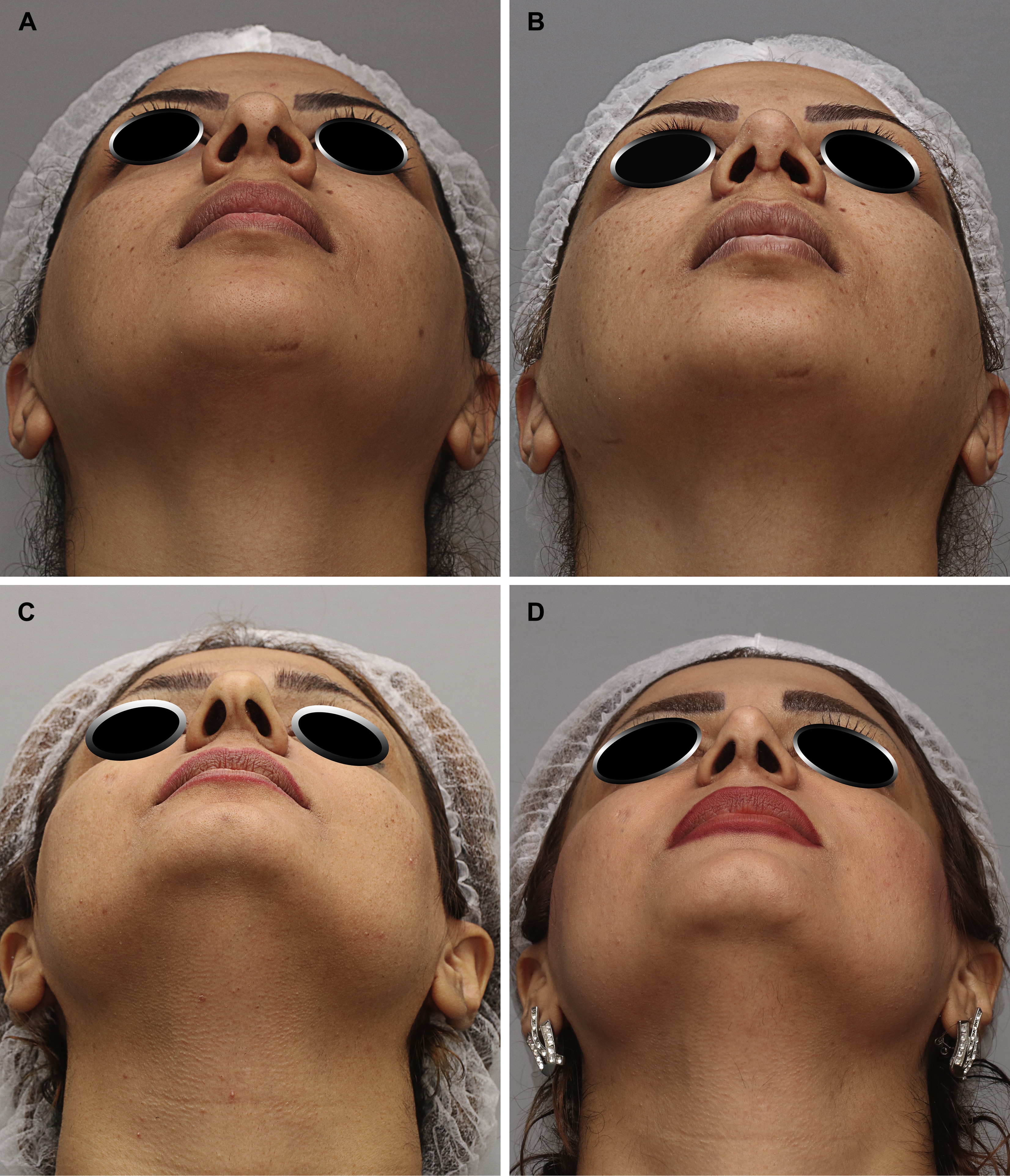 plastic surgeon nose job
