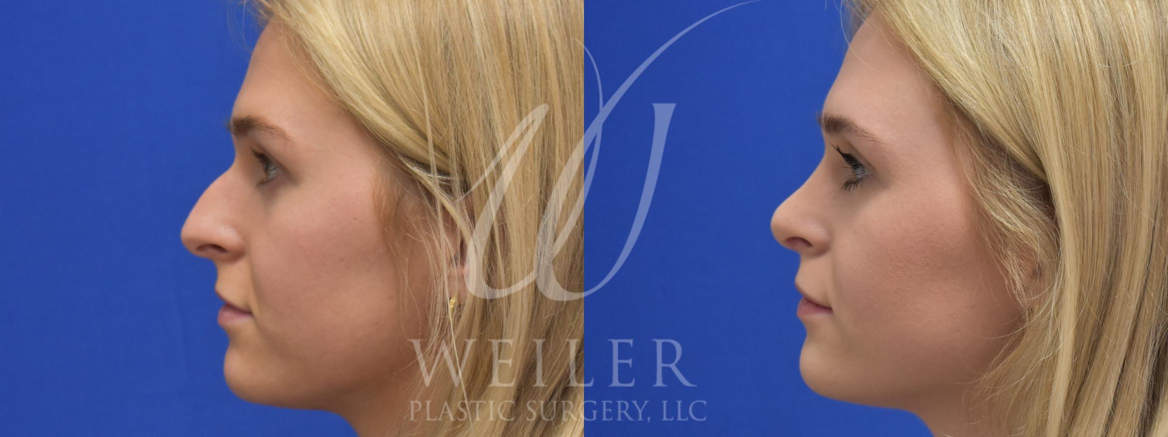 plastic surgeon nose job